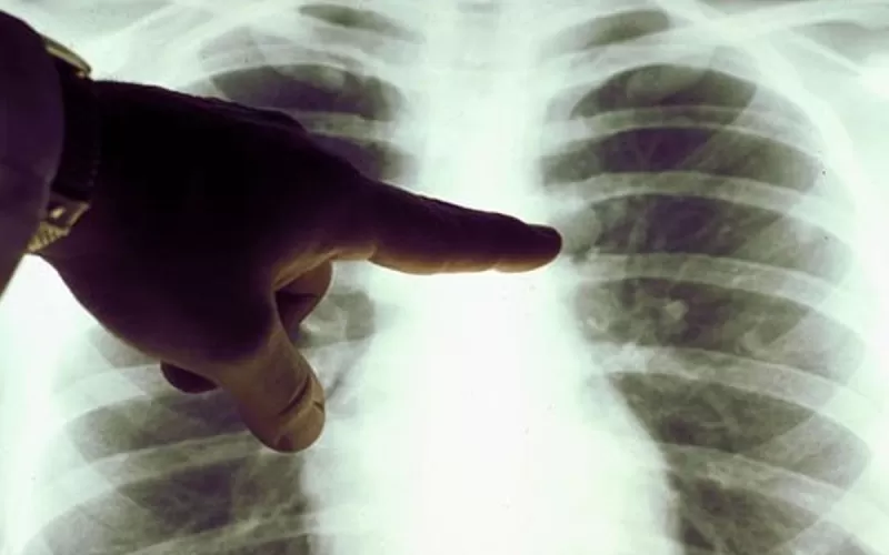 C&aacute;ncer en menores de 50: el informe que sacude a la salud internacional